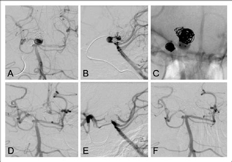 Figure 2 From Jailed Double Microcatheter Technique Following