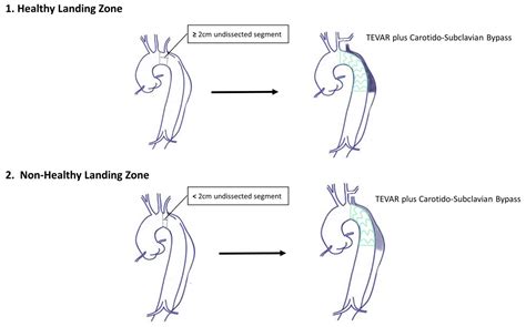 Long Term Outcomes In Thoracic Endovascular Aortic Repair For