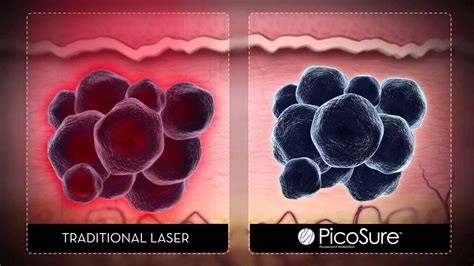 Cancer Types: Types Of Lung Cancer Surgery