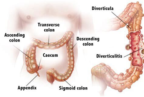 Enfermedad Diverticular Síntomas Y Tratamiento Salud Y Cuidados