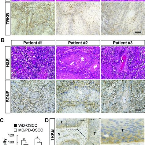 Elevated Expressions Of Trkb And Bdnf In Moderately Or Poorly