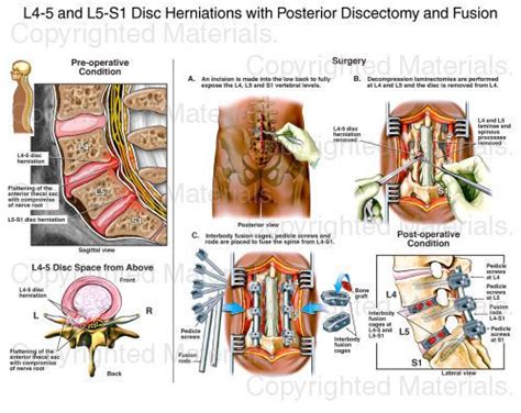 L And L S Disc Herniations With Posterior Discectomy And Fusion