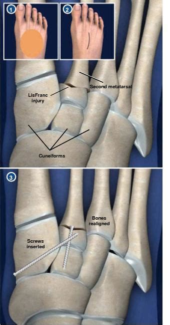 Fixation For Lisfranc Injury Houston Tx Spring Branch Podiatry Pllc