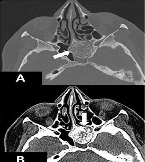 A 51 Year Old Woman Axial Unenhanced Ct Images Through The Sphenoid