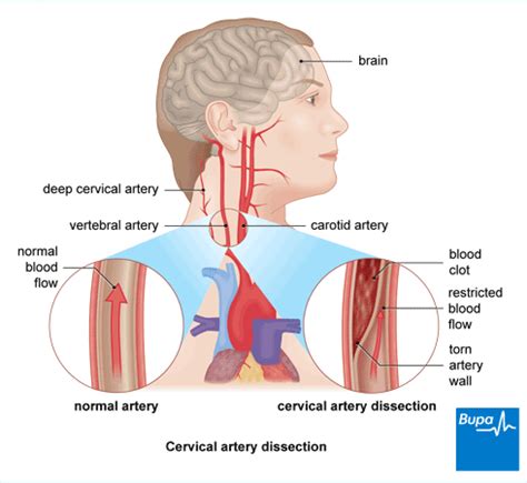 POTD: Cervical Artery Dissection — Maimonides Emergency Medicine Residency