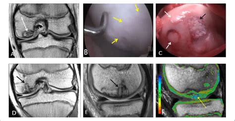 an 11-year-old male who had repair of an osteochondral lesion by... | Download Scientific Diagram