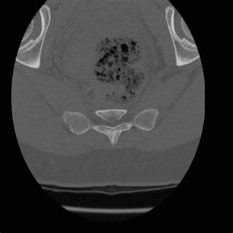 Sacral Fracture Image