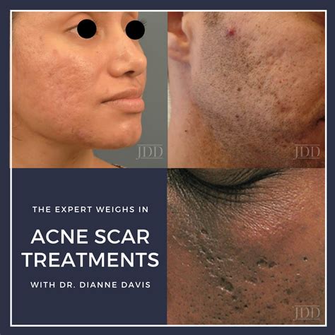 How To Best Treat Acne Scars And Discoloration For Smooth 40 Off