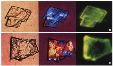 Cholesterol Crystals