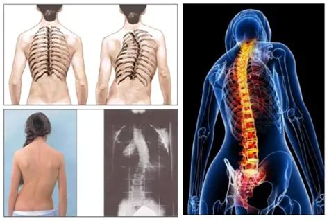 Enfermedades Más Comunes En La Columna Vertebral