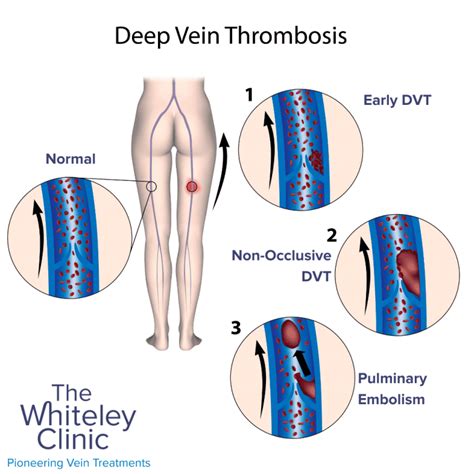 How To Tell If You Have Dvt The Whiteley Clinic