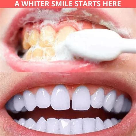 How To Whiten Teeth At Home Fast With This 1 Effective Method Artofit