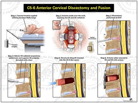 C5 6 Anterior Cervical Discectomy And Fusion