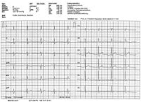 Abbildungen Und Graphiken EKG Beispiel AV Block I Grades