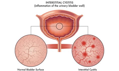 Interstitial Cystitis Treatment: A Multifaceted Approach - Propel ...