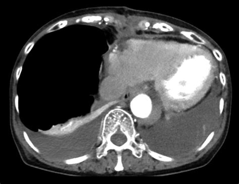 Double Roi Timing Bolus Technique To Perform Aortic Ct Angiography With