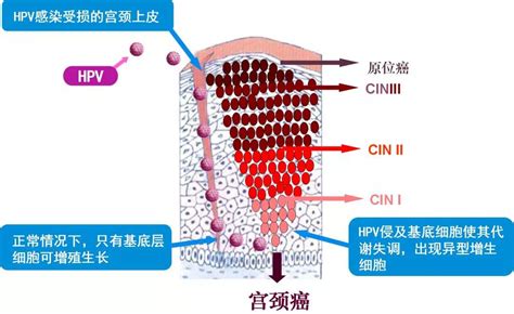 早癌公益筛查重在坚持 我们一直在努力 公益 筛查 坚持 宫颈癌 Cin 刘女士 癌症 健康界