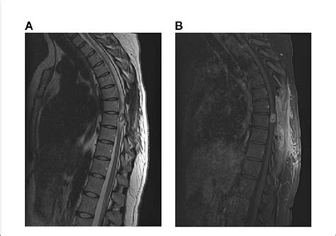 FIGURE Post-operative MRI with and without contrast of the spine [(A):... | Download Scientific ...