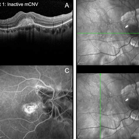 A Optical Coherence Tomography Oct B Scan Through The Macula Green