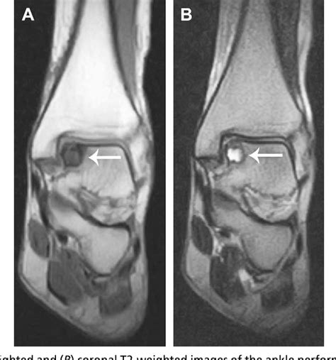 Osteochondral Lesion Ankle