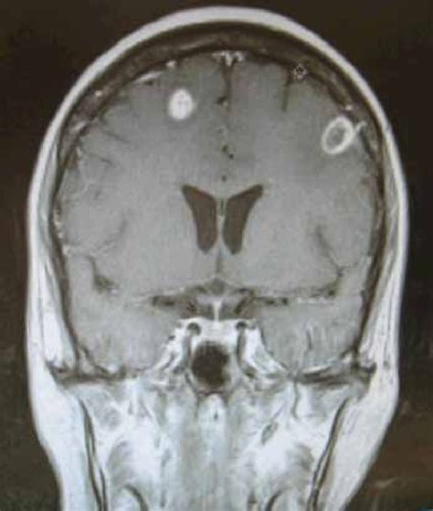 Magnetic Resonance Imaging Of Brain Showing Abscesses Download Scientific Diagram