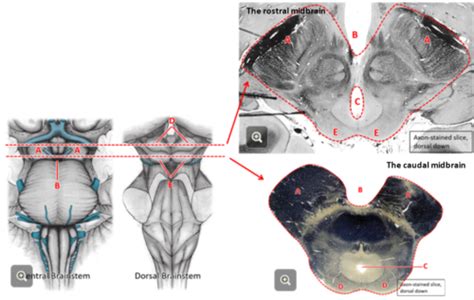 Brainstem In Cross Section And Mri Flashcards Quizlet