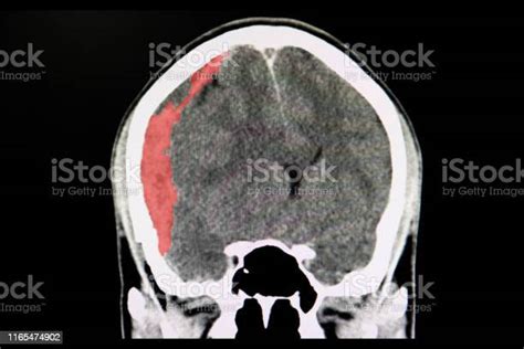 Ct Scan Pasien Trauma Dengan Pendarahan Otak Foto Stok Unduh Gambar