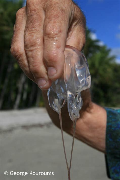 Stung by a Box Jellyfish - Australia