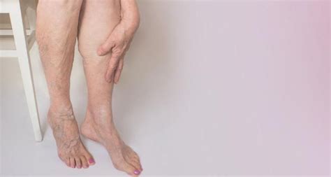 Common Signs Of Venous Insufficiency You Should Know Alate Health