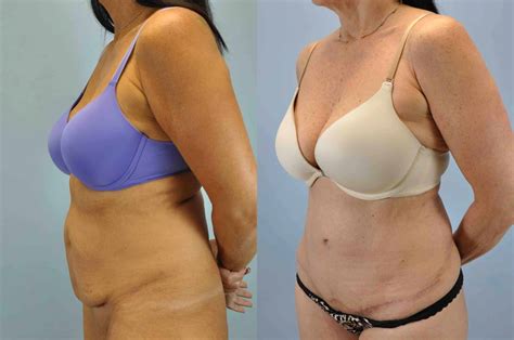 Tummy Tuck Gallery Dr Paul Vanek Md