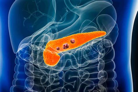 Microbiota Derived Metabolite May Help Combat Pancreatic Cancer