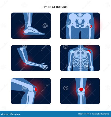 Bursitis Icons Set Cartoon Vector Cartoondealer