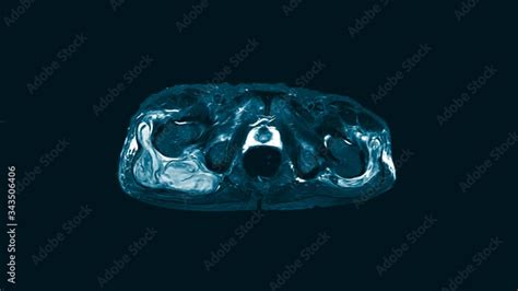 Magnetic Resonance Imaging Mri Of Both Hip Sagittal Plane Finding A