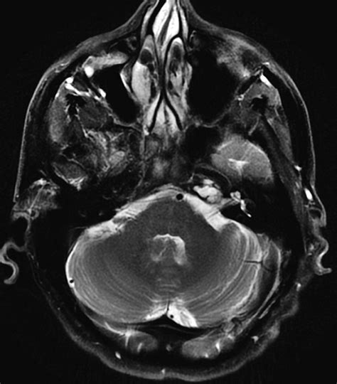 Epidermoid Petrous Apex