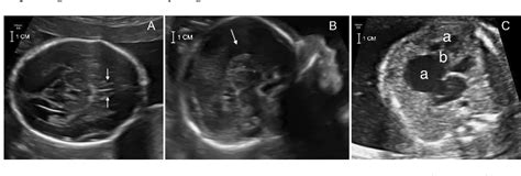 Figure From Utr Deletion Of Nono Leads To Corpus Callosum Anomaly