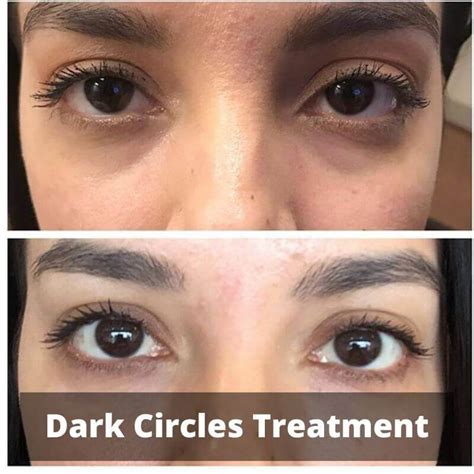 Dark Circle Treatment Prp Treatment Center