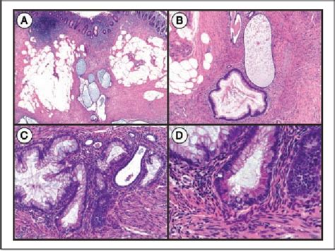 Figure 1 From Colonization Of Intestinal Endometriosis By Benign