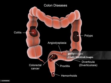 Medical Illustration Showing Types Of Colon Diseases High Res Vector