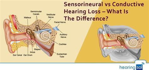 Conductive Vs Sensorineural Hearing Loss What Is The Difference Hearing Loss Hearing