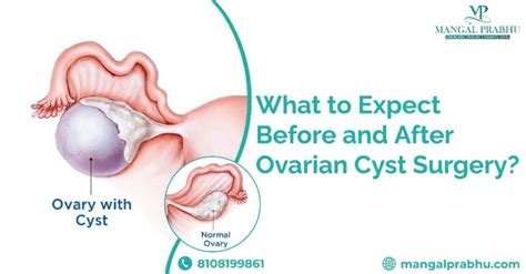 Before And After Ovarian Cyst Surgery