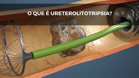 O que é Ureterolitotripsia Cirurgia de Pedra nos Rins YouTube