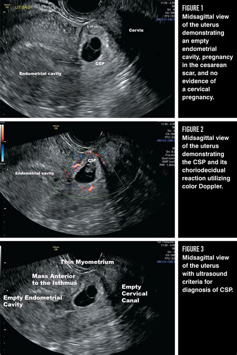 How To Diagnose And Treat Cesarean Scar Pregnancy