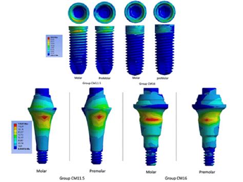 Implant Stress Maps And Abutment Stress Maps For Groups Cm11 5 And Cm16 Download Scientific