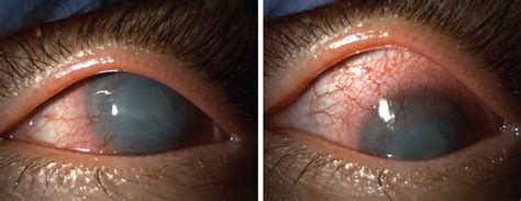 Attacking Acanthamoeba Keratitis