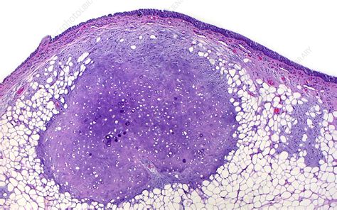 Lung hamartoma, light micrograph - Stock Image - C057/1441 - Science ...