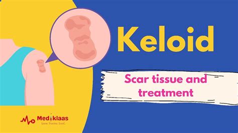 Keloid Scar Tissue And Treatment Youtube