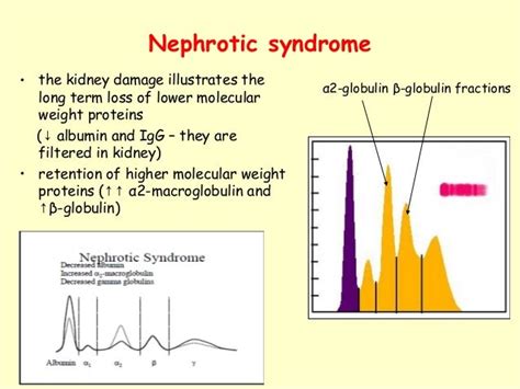 Interpreting Serum Protein Electrophoresis