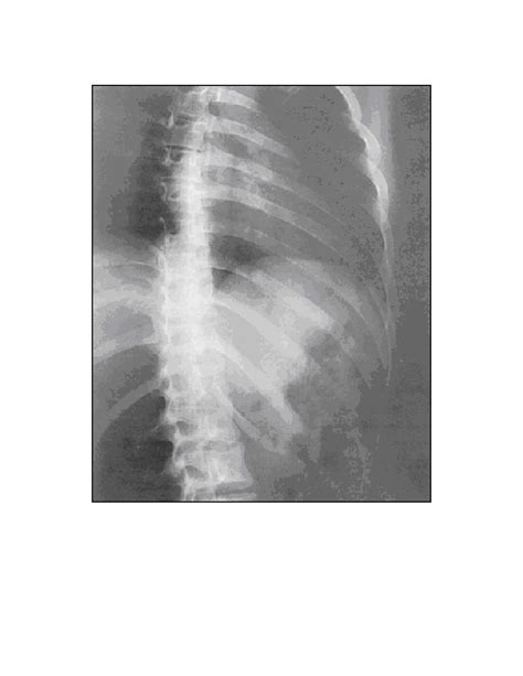 Oblique Rib Below Diaphragm Standard Positioning Techniques Ii