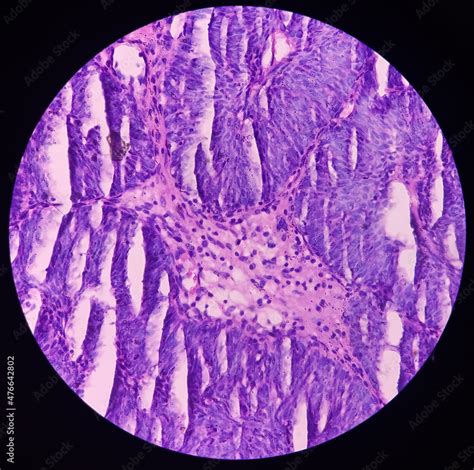 Urinary Bladder Cancer Microphotograph Transitional Cell Carcinoma