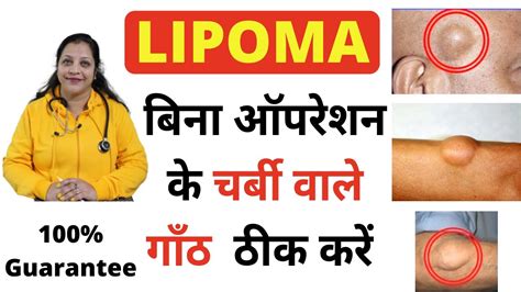 Homeopathic medicine for lipoma charbi ki ganth ka ilaj चरब क